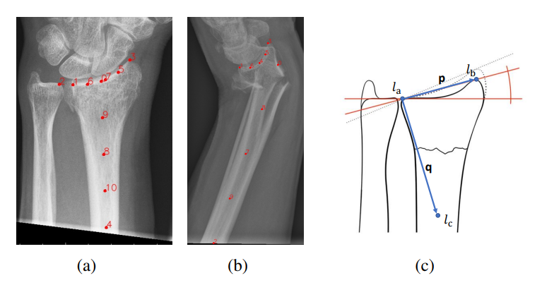 A Landmark-based Approach for Instability Prediction in Distal Radius Fractures
