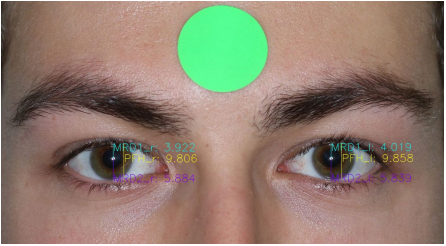 Normal periocular anthropometric measurements in an Australian population