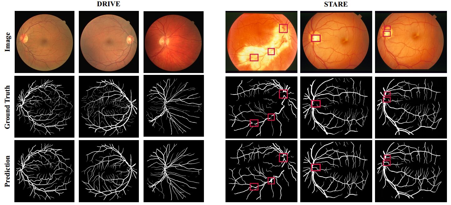 EAR-NET: Error Attention Refining Network For Retinal Vessel Segmentation